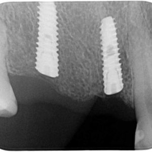 PFP-ioi-4-implantes-dentales-1
