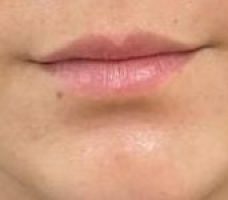 Relleno labios | Antes