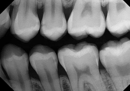 Rx-retro-TA-Radiografia-dental