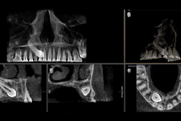 escaner-óseo-TA-radiografía-dental