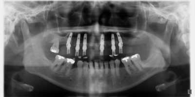 ioi-2-TA-implante-dental.jpg