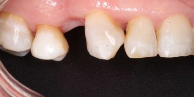 ioi-4-TA-implante-dental.jpg