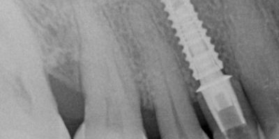 ioi-6-TA-implante-dental.jpg