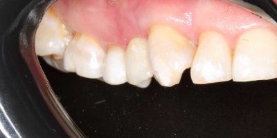 ioi-7-TA-implante-dental.jpg